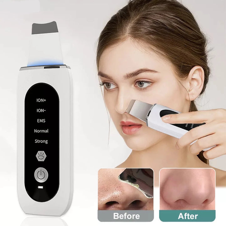 Ultrasonic Blackhead Remover